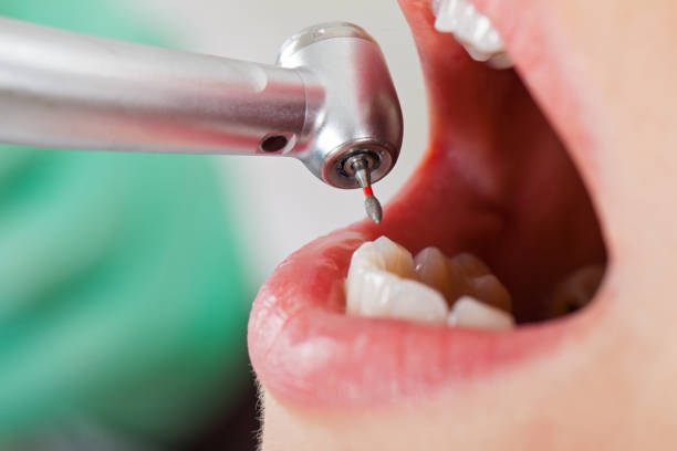 Best Emergency Dentist for Lost Fillings or Crowns in Oakwood Hls, IL